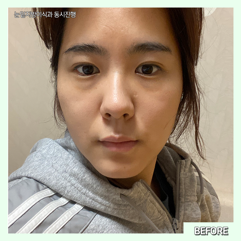 눈밑지방재배치전후 확인하고 가세요~! 관련 이미지 3
