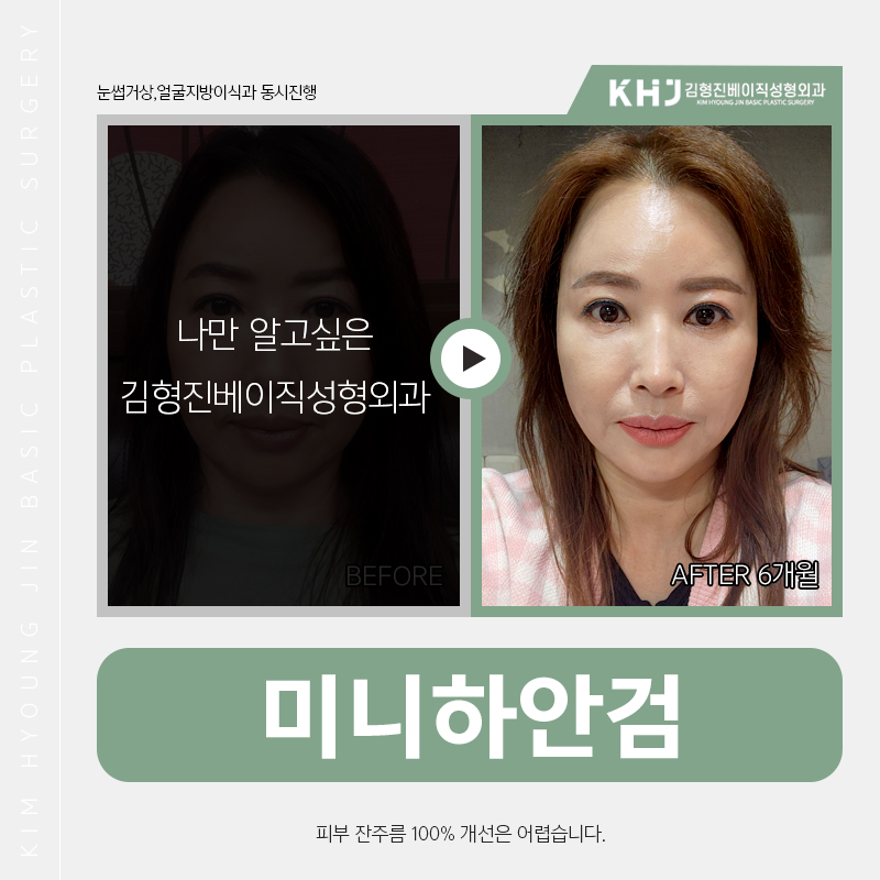 미니하안검효과 궁금하시다구요? 관련 이미지 3