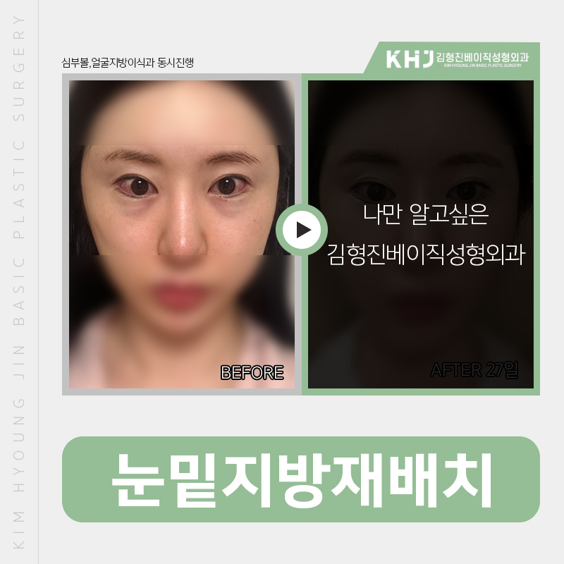 눈밑다크서클 걱정하실필요 없어요! 관련 이미지 2