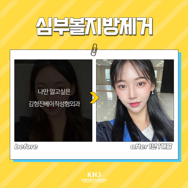 심부볼제거수술 볼패임 없이 할 수 있는 곳? 관련 이미지 7