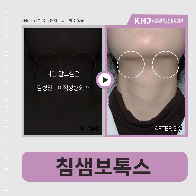 침샘보톡스후기 궁금하신분?? 관련 이미지 3