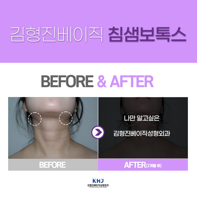 침샘보톡스잘하는곳에서 작은 얼굴 만들기 성공! 관련 이미지 5