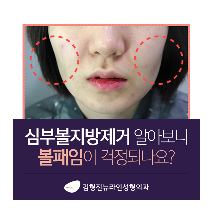 하악심부볼지방제거 볼패임을 잡다 관련 이미지 2