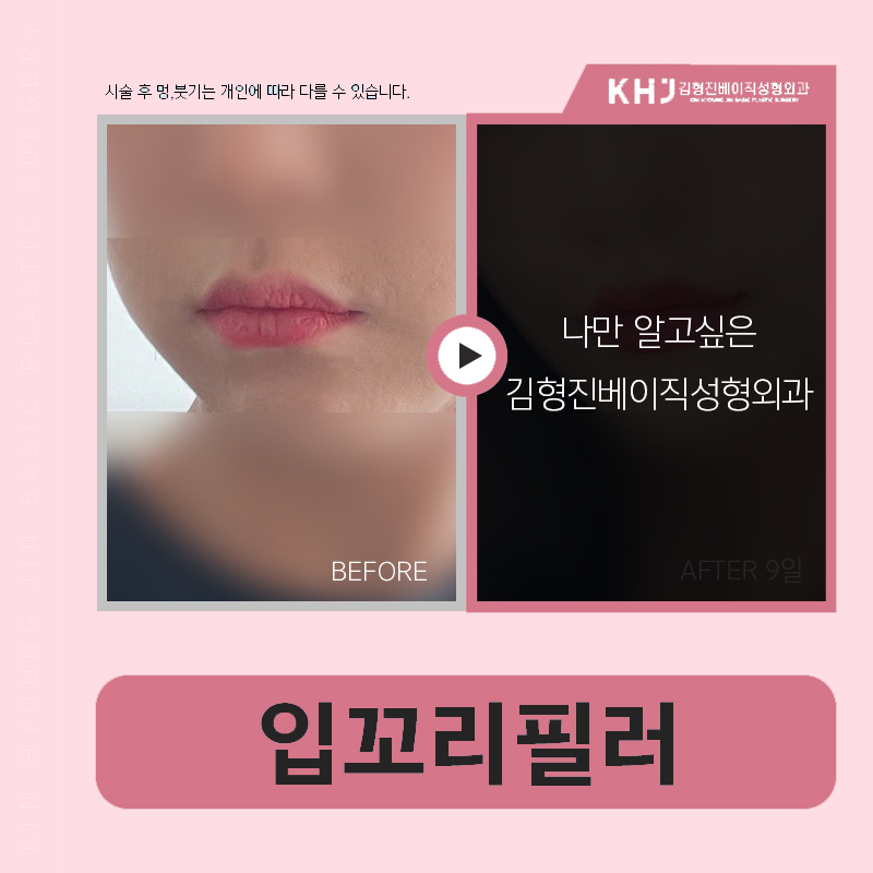 Want to see a clear lip-corner filler effect? image 5