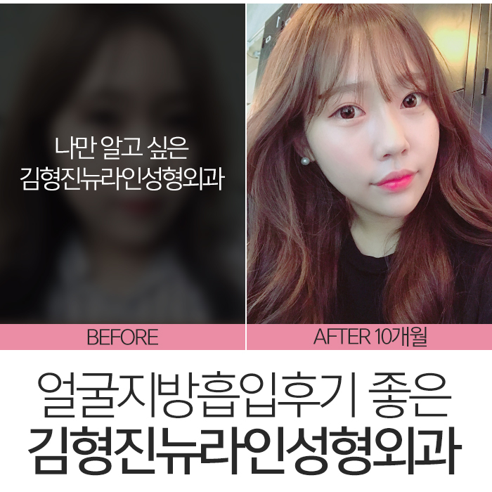 얼굴지방흡입후기 완벽 변신! 관련 이미지 7