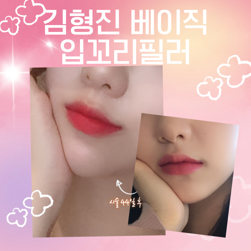 강남입꼬리필러 맛집, 입소문에는 다 이유가 있네요 관련 이미지 4