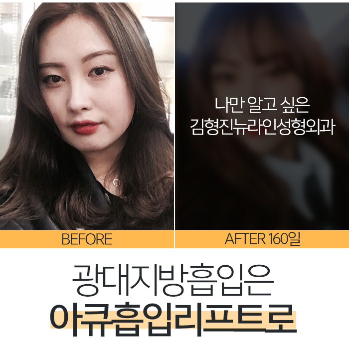 광대살지방흡입 이렇게 하는 거였어? 관련 이미지 5