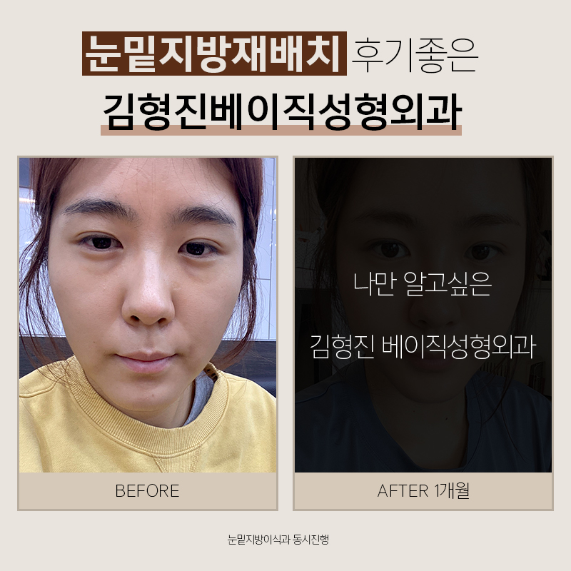 눈밑지방재배치후기 봐주실 분 관련 이미지 8
