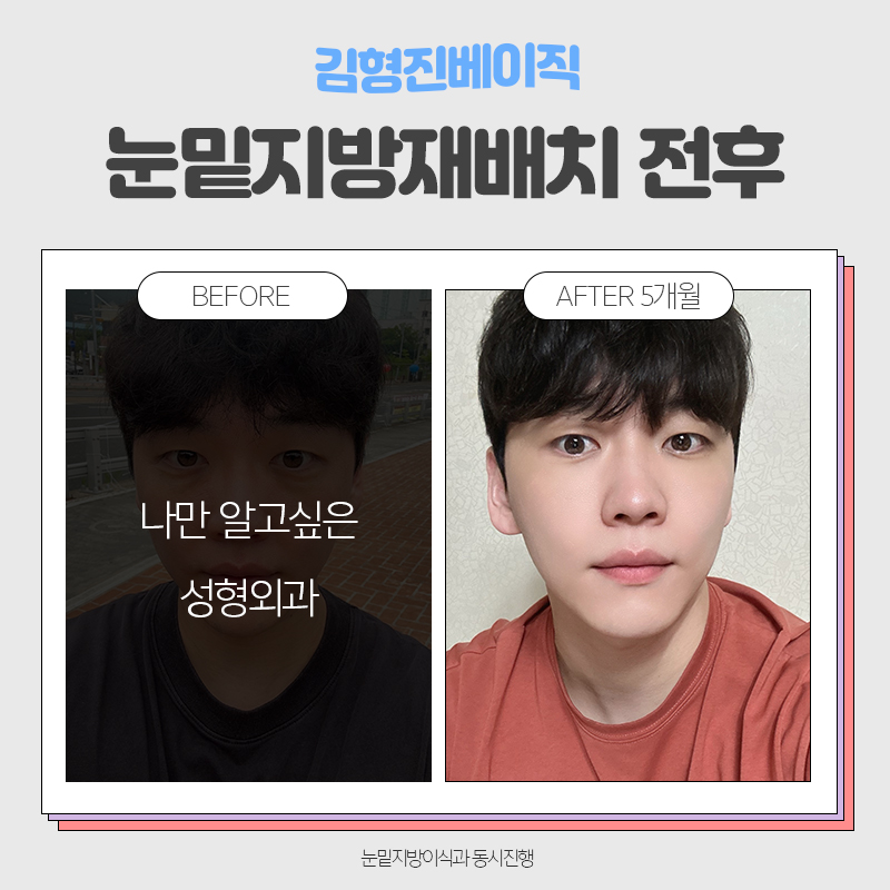 눈밑지방재배치전후 보러오실분 관련 이미지 3