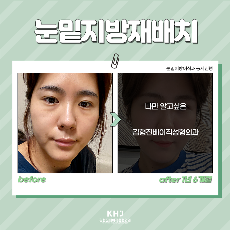 눈밑지방재배치유지력 오래가는 수술방법 찾으셨다면! 관련 이미지 2