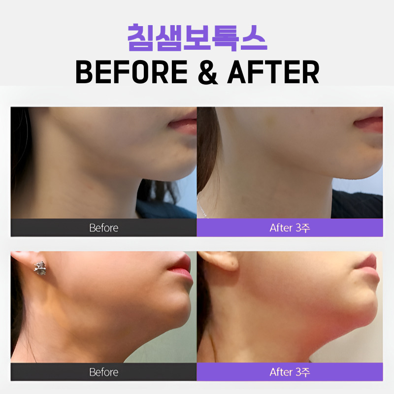 침샘비대증치료에는 이만한 곳이 없어요 관련 이미지 5