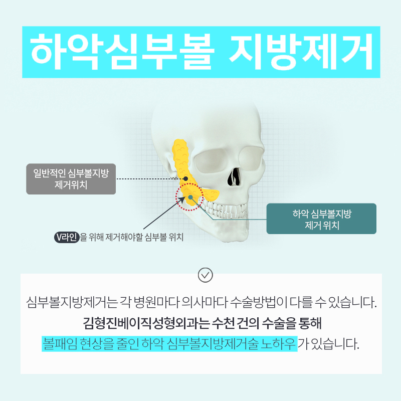 얼굴살 빼고싶다면 얼지흡후기 보고 결정하세요 관련 이미지 5