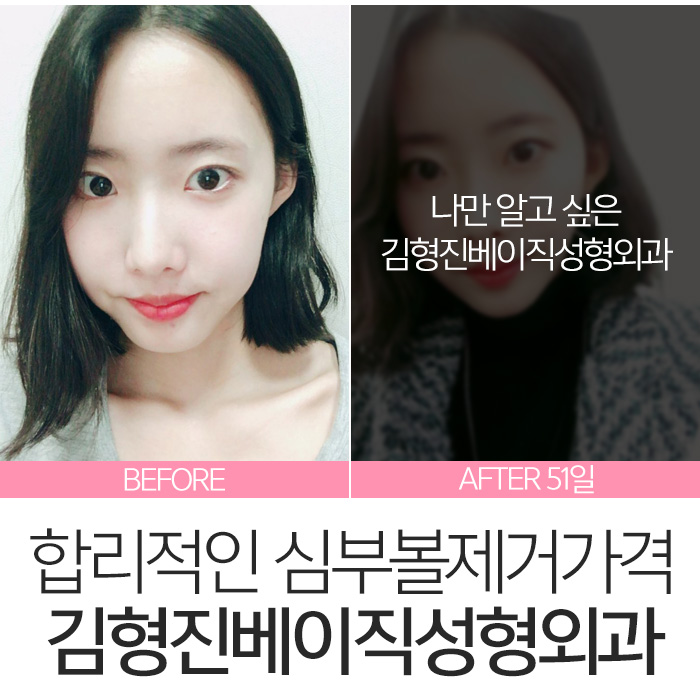 심부볼지방제거가격 싼 곳 보다는 실력이 중요! 관련 이미지 3