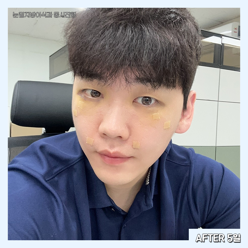 눈밑지방재배치변화과정 한눈에 확인하고 가세요! 관련 이미지 5