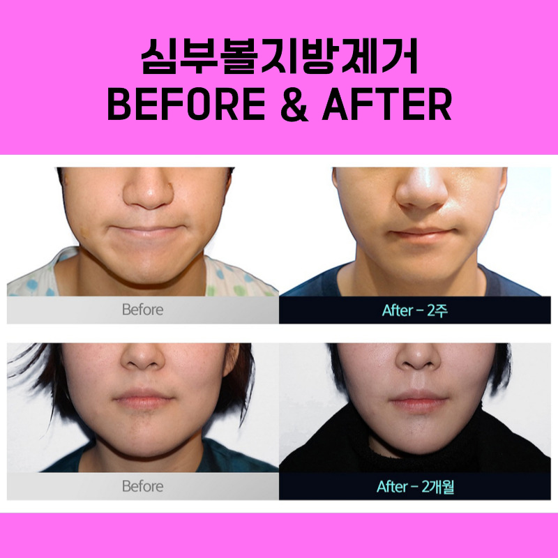 I Achieved Both Deep Cheek Fat Removal and a Lifting Effect! image 5