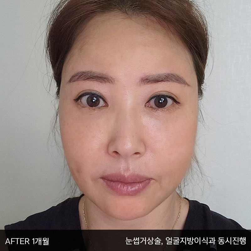 중년눈밑지방수술 아직 모르신다면 관련 이미지 6