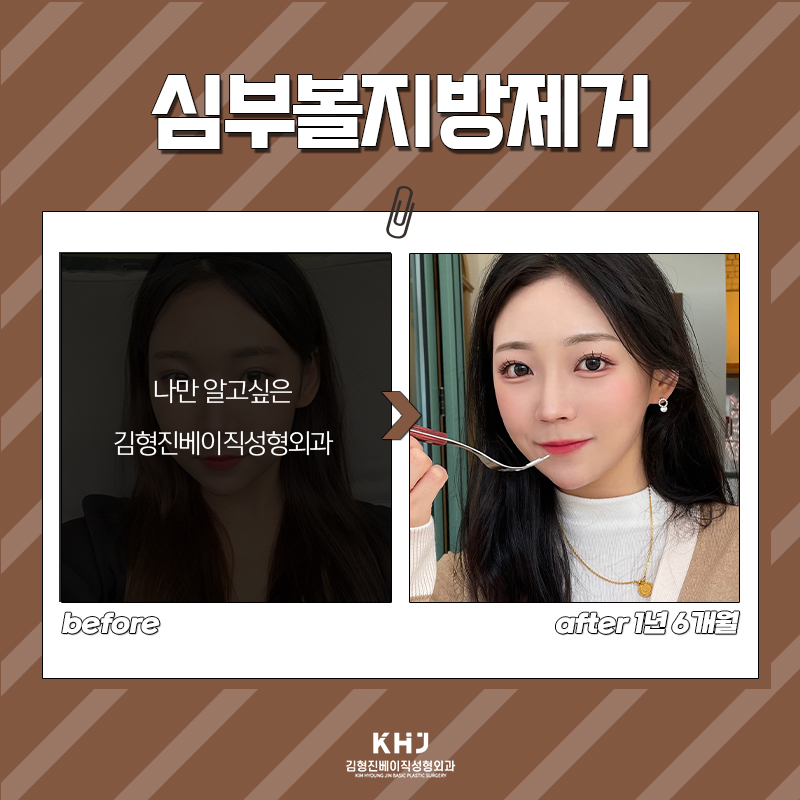 압구정심부볼제거 심술보 같은 불독살이 고민이라면? 관련 이미지 7