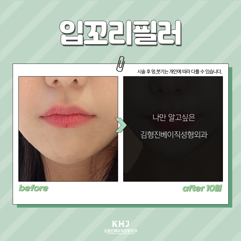 입꼬리필러전후 보여드립니다! 관련 이미지 5
