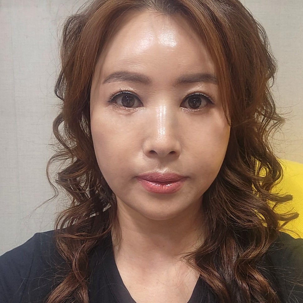 중년하안검으로 나이 들어 보이는 원인 해결했어요 관련 이미지 1