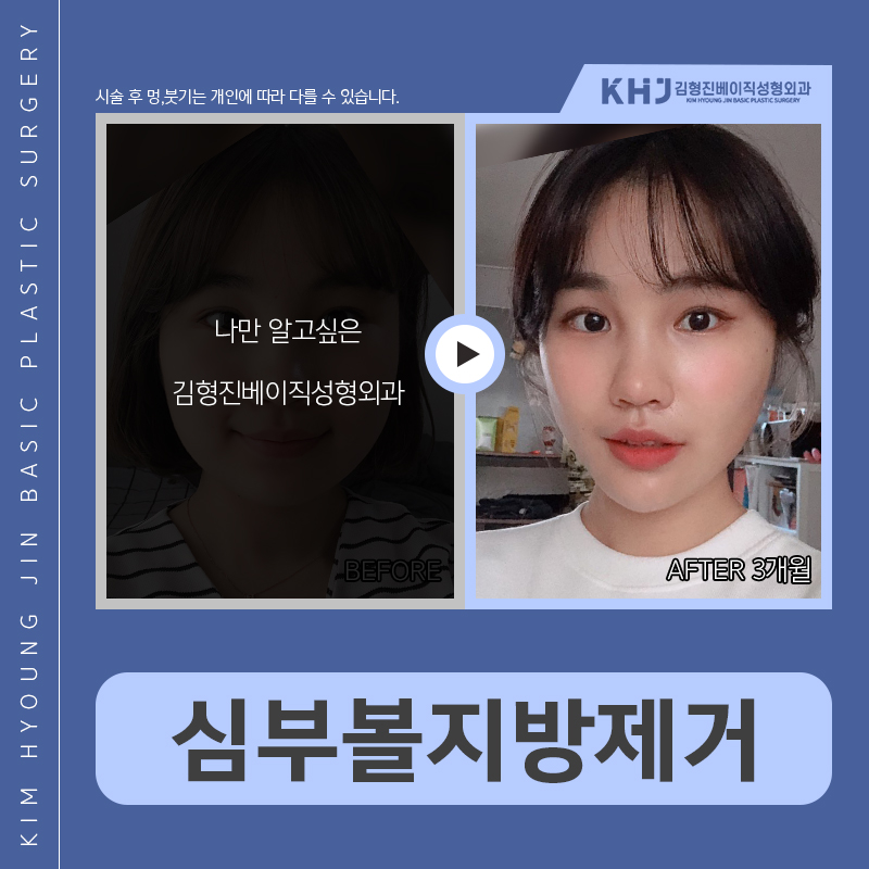 심부볼윤곽주사 과연 효과 있을까요? 관련 이미지 5