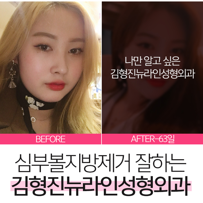 심부볼지방제거성형외과 김형진뉴라인, 알죠? 관련 이미지 2