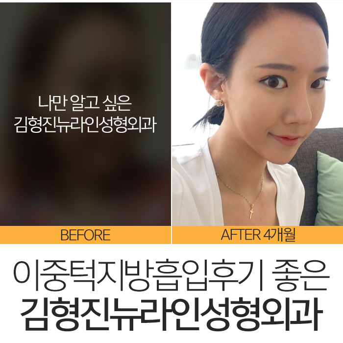 이중턱지방흡입후기 솔직하게 관련 이미지 2