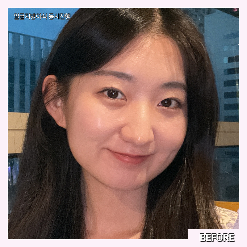 얼굴지방흡입효과 제대로 보려면 관련 이미지 2