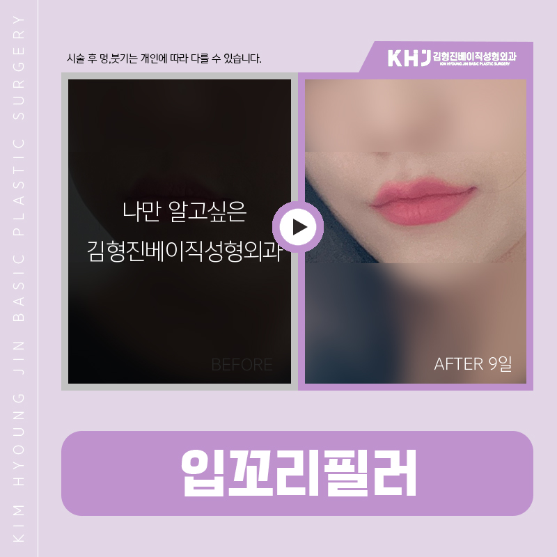 입꼬리올리는방법 진짜 알려드릴까요? 관련 이미지 6