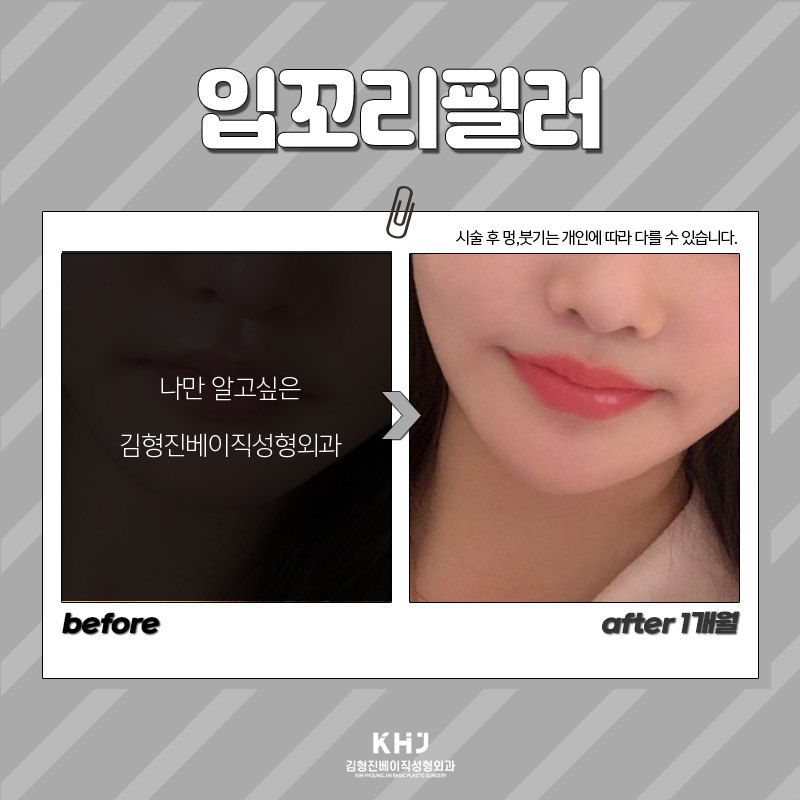 입꼬리에 진심인 김형진베이직의 리얼한 입꼬리필러후기 관련 이미지 6