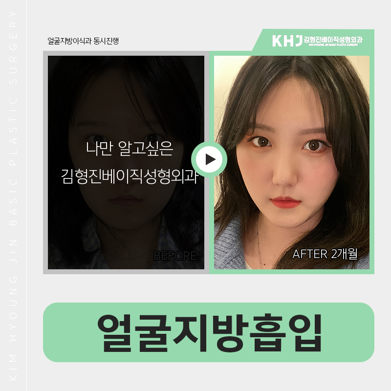 얼굴지방흡입방법 어떻게 진행되냐구요? 관련 이미지 6