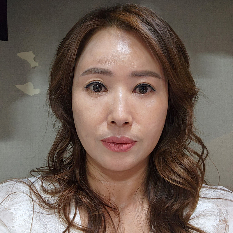 미니하안검흉터 김형진베이직에서는 걱정 없어요! 관련 이미지 1