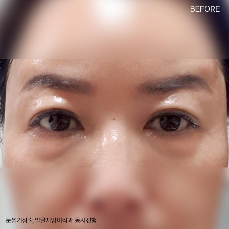 미니하안검회복과정 한 눈에 확인! 관련 이미지 2