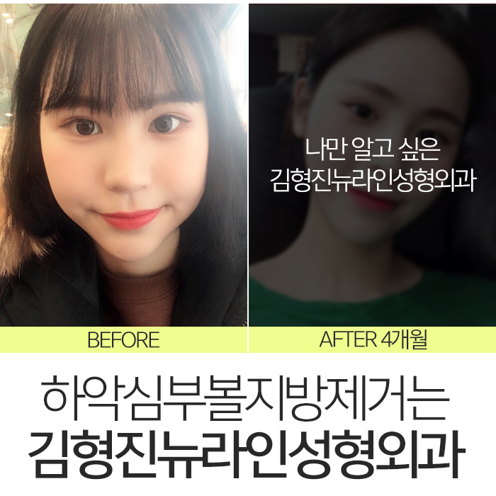 하악심부볼지방제거 잘하는곳에서 해야죠 관련 이미지 8