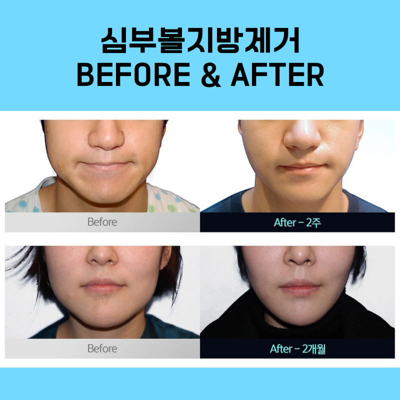 Deep Cheek Fat Removal Reviews: If You Haven’t Found a Good Clinic image 6