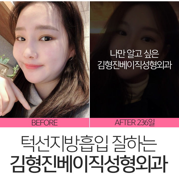 턱선지방흡입 김형진베이직성형외과 짜란다 관련 이미지 2