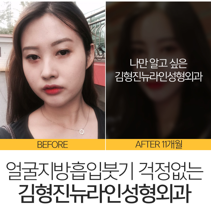 얼굴지방흡입붓기 요즘 누가 걱정해? 관련 이미지 7