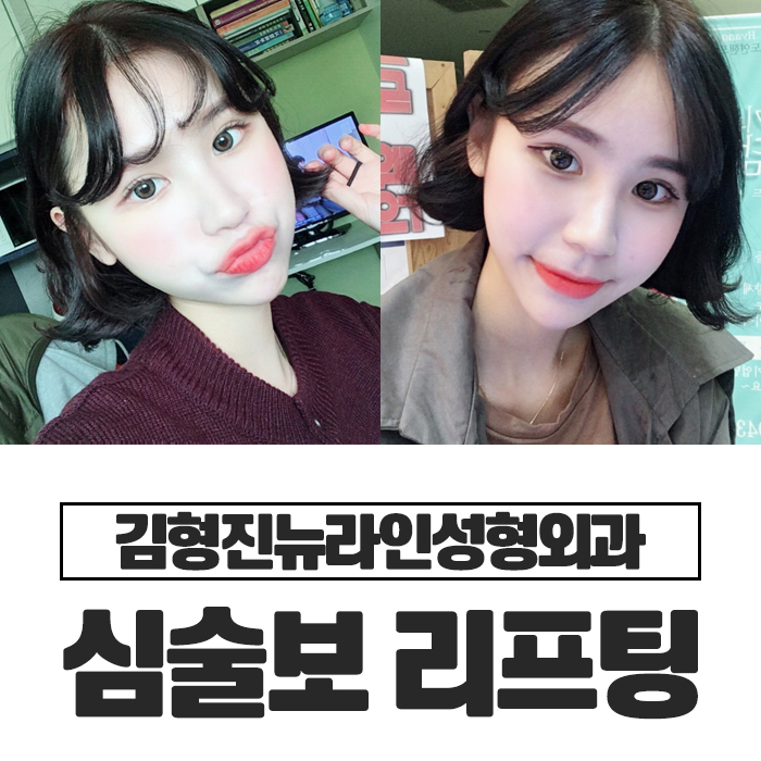 심술보리프팅 김형진뉴라인에서는? 관련 이미지 1