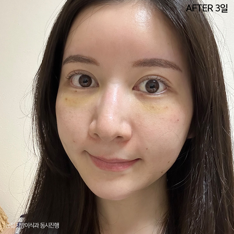 눈밑지방재배치효과 궁금하시죠? 관련 이미지 3