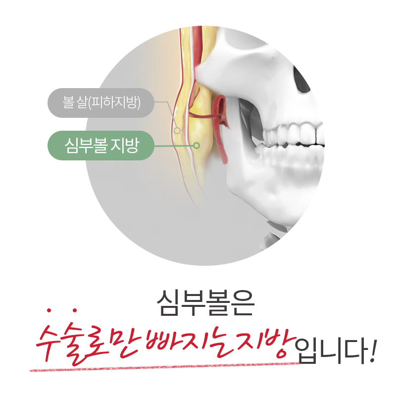 인모드 심부볼, 해결 안 되는 이유는 이거! 관련 이미지 2