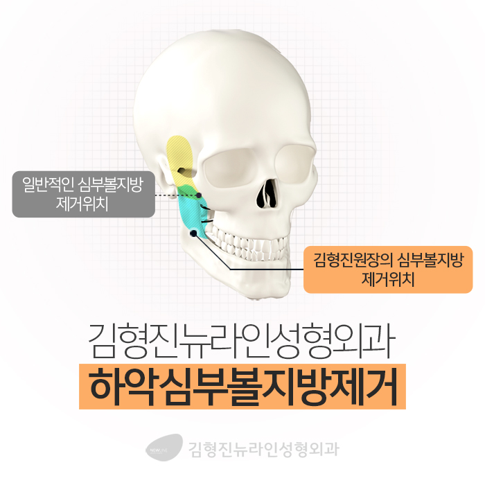 심부볼성형 능력자 김형진원장님! 관련 이미지 3