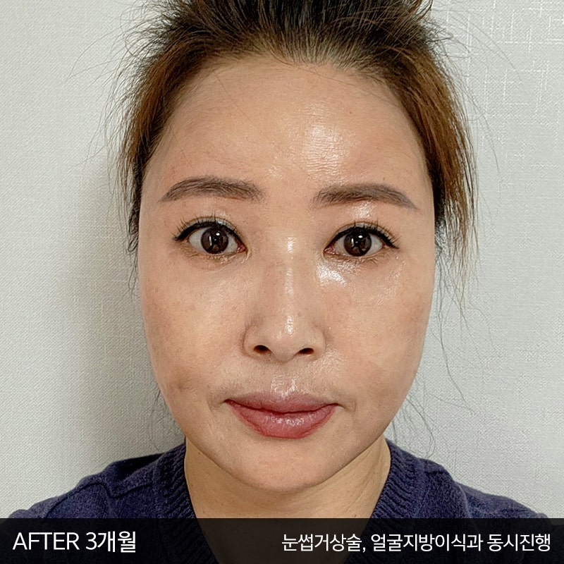 중년눈밑처짐 해결방법은 관련 이미지 7