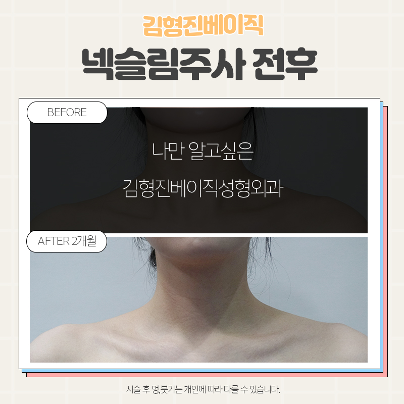 목보톡스전후 궁금하셨다면 여기로! 관련 이미지 5