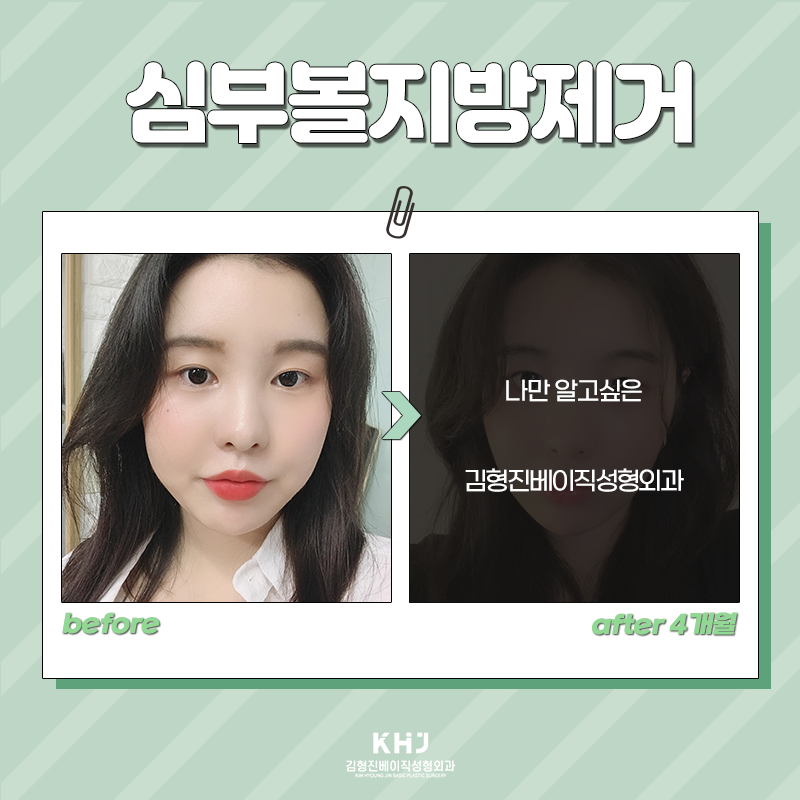 심부볼제거전후 후기 좋은 곳 찾으셨나요? 관련 이미지 2