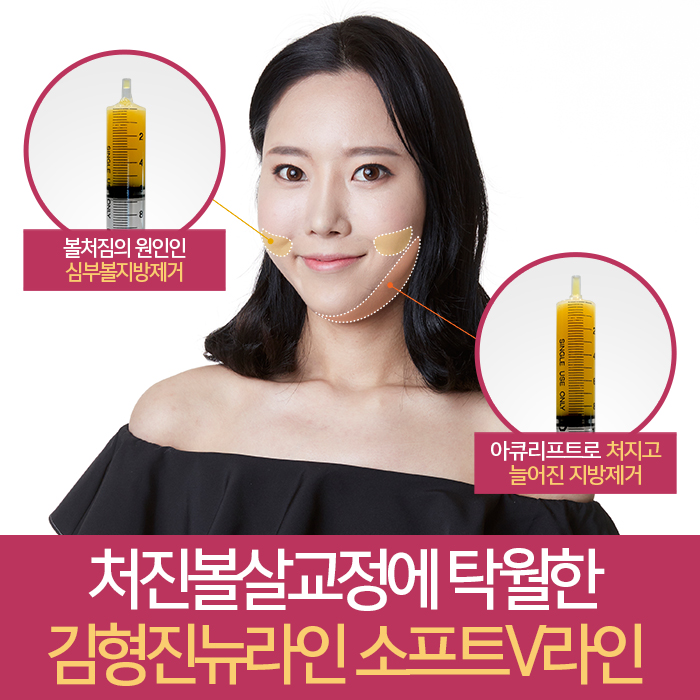 처진볼살교정 하고싶다면 관련 이미지 3