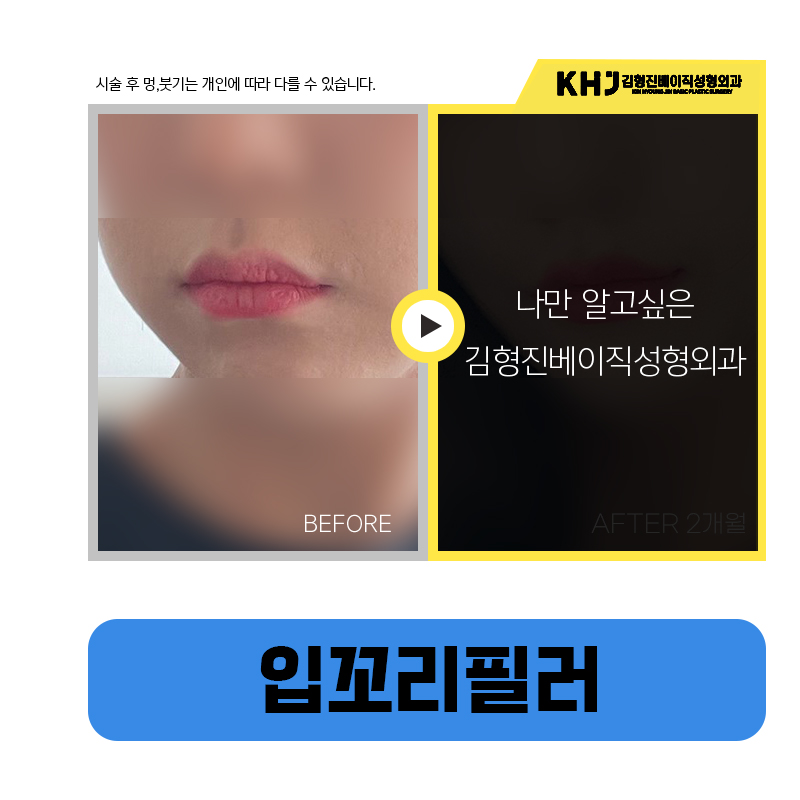 처진입꼬리 교정으로 인상이 달라졌어요 관련 이미지 5