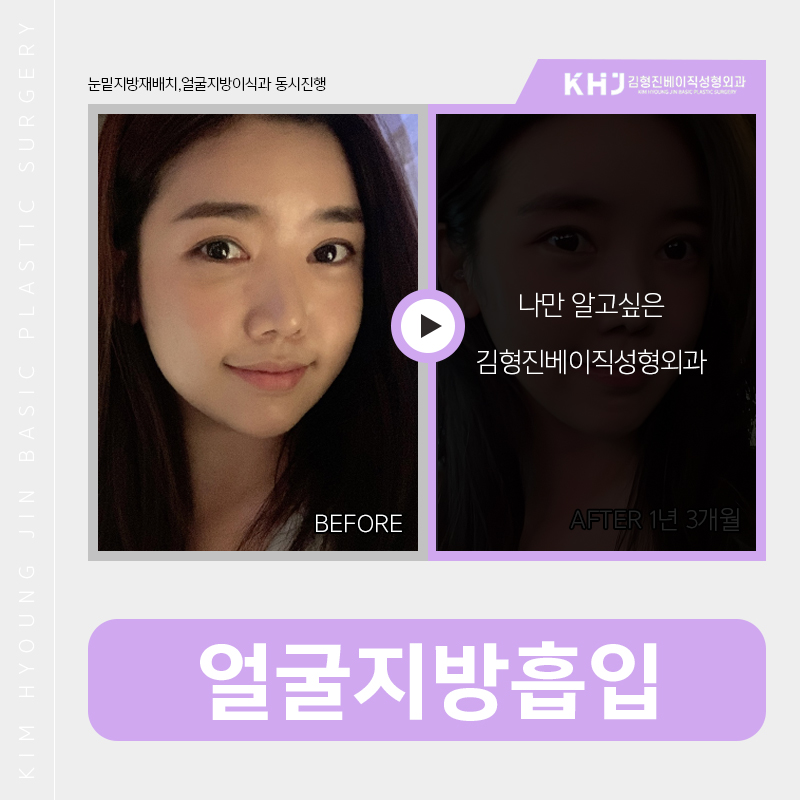 얼굴지방흡입붓기 걱정이시라구요? 관련 이미지 5