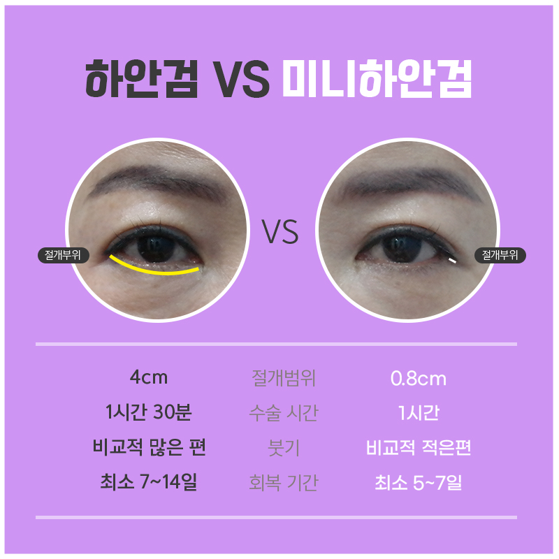 중년눈밑처짐 해결방법 찾고 계셨다면 관련 이미지 3