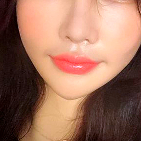 You can create more vibrant lips with just a mouth-corner filler procedure! image 3