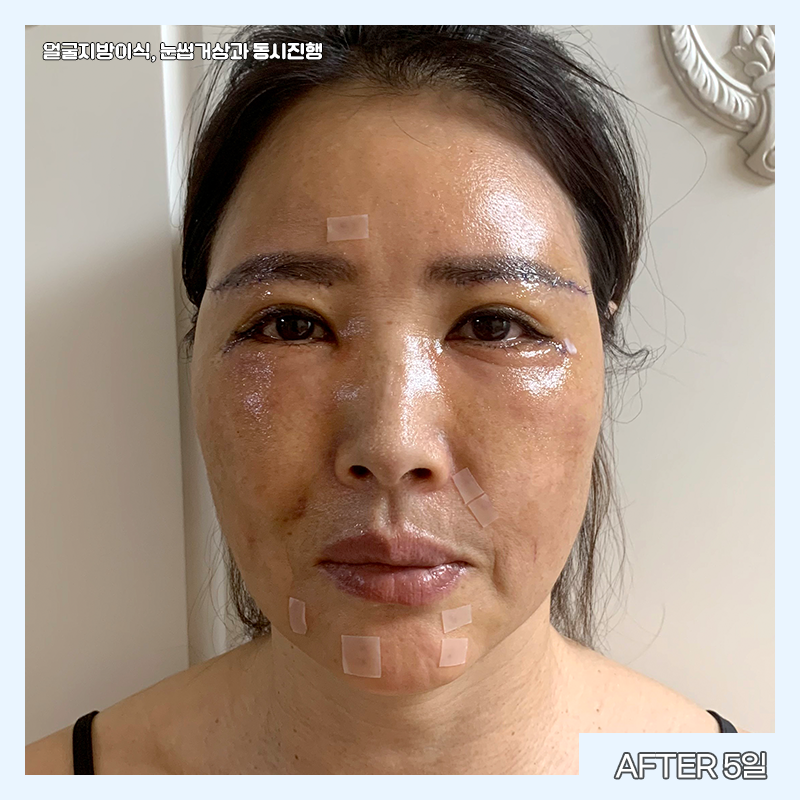 중년눈밑수술 김형진베이직에서 해야 하는 이유 관련 이미지 3