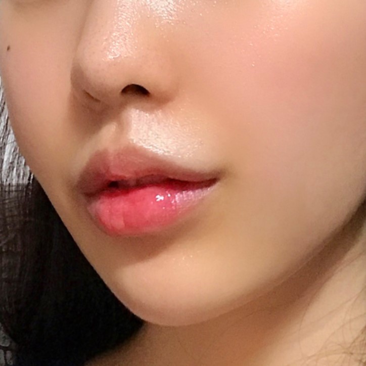 축 처진 입매 교정하는 입꼬리필러시술이 궁금하다면 관련 이미지 3